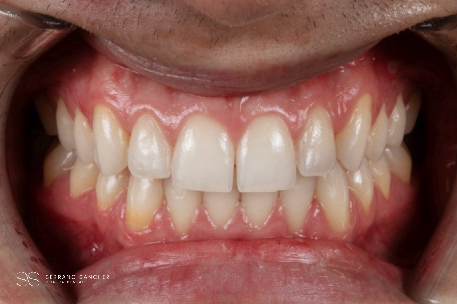 2026 caso 01 rehabilitacion estetica antes Clínica Serrano Sánchez