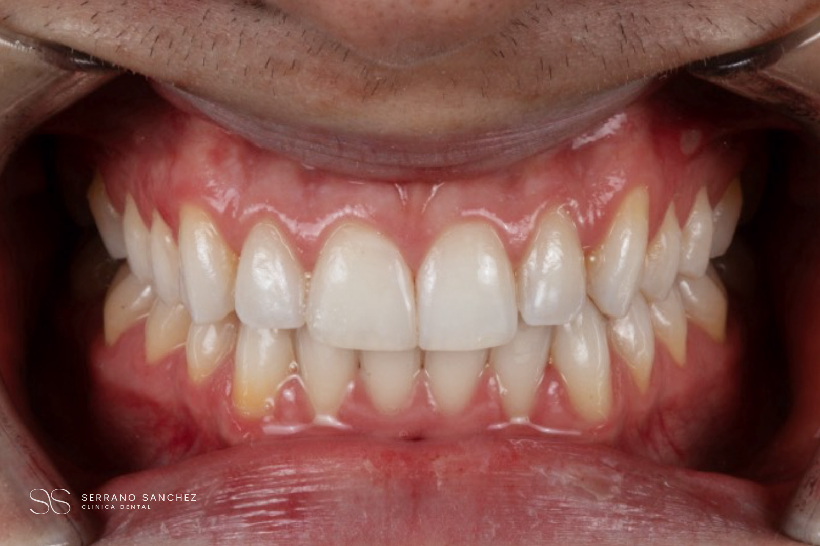 2026 caso 01 rehabilitacion estetica despues Clínica Serrano Sánchez