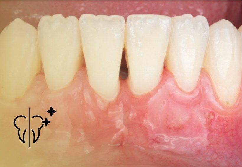 Cases Before and After: Gum Graft 3 cabecera casos injerto encia 1 Clínica Serrano Sánchez