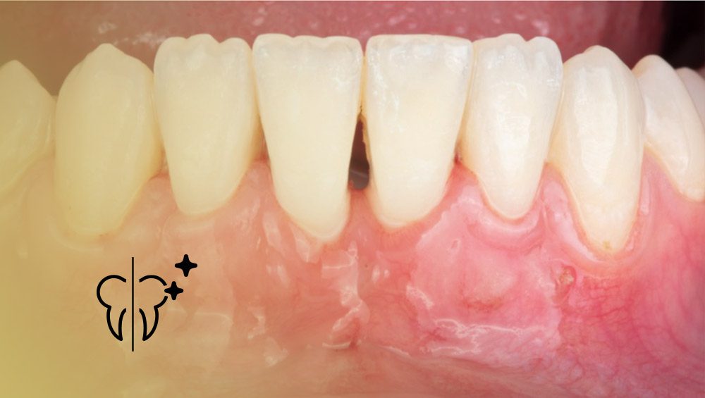Cases Before and After: Gum Graft 5 cabecera casos injerto encia 1 Clínica Serrano Sánchez