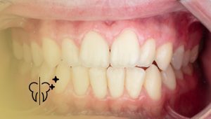 Casos antes y después: Tratamiento periodontal 17 Casos antes y después: Tratamiento periodontal