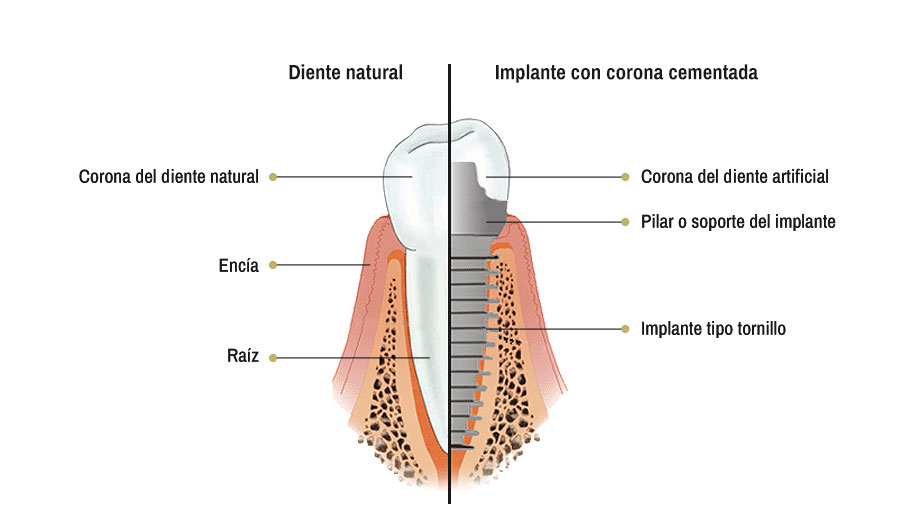 implantologia serrano sanchez Clínica Serrano Sánchez