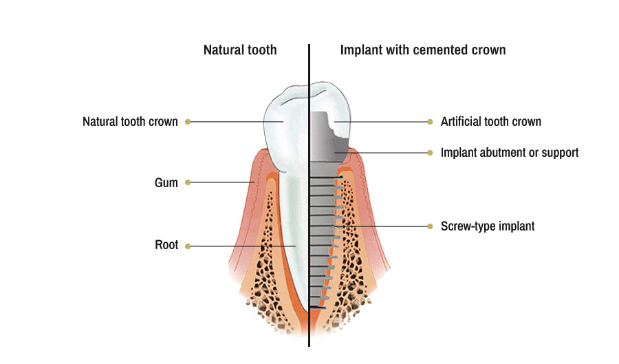 implants serrano sanchez Clínica Serrano Sánchez