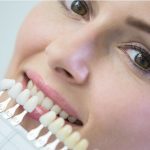 SerranoSanchez dientes carillas Clínica Serrano Sánchez