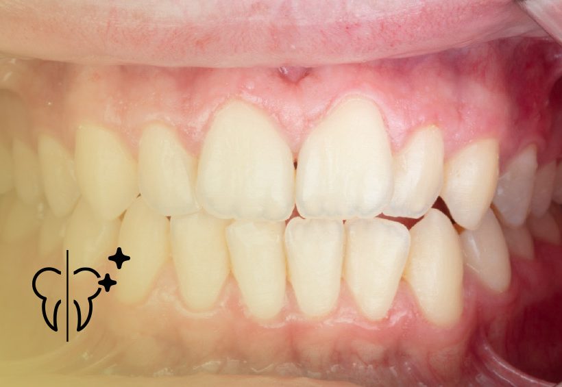 Cases Before and After: Periodontal Treatment 1 cabecera casos tratamiento periodontal Clínica Serrano Sánchez