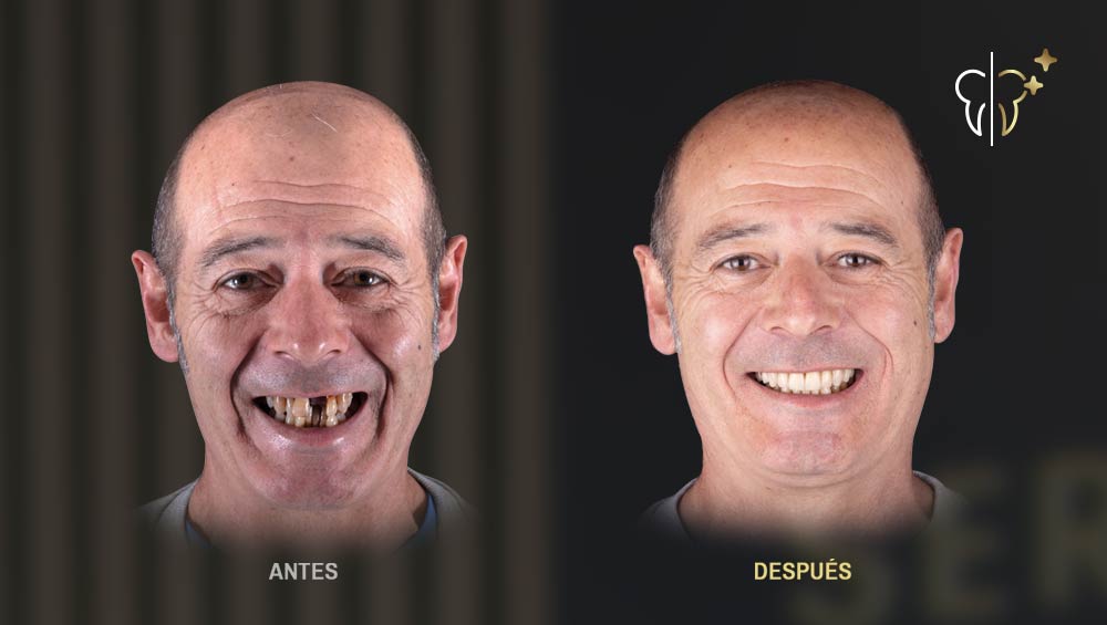 rehabilitación dental integral de frente