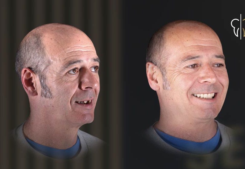rehabilitación dental integral de lado