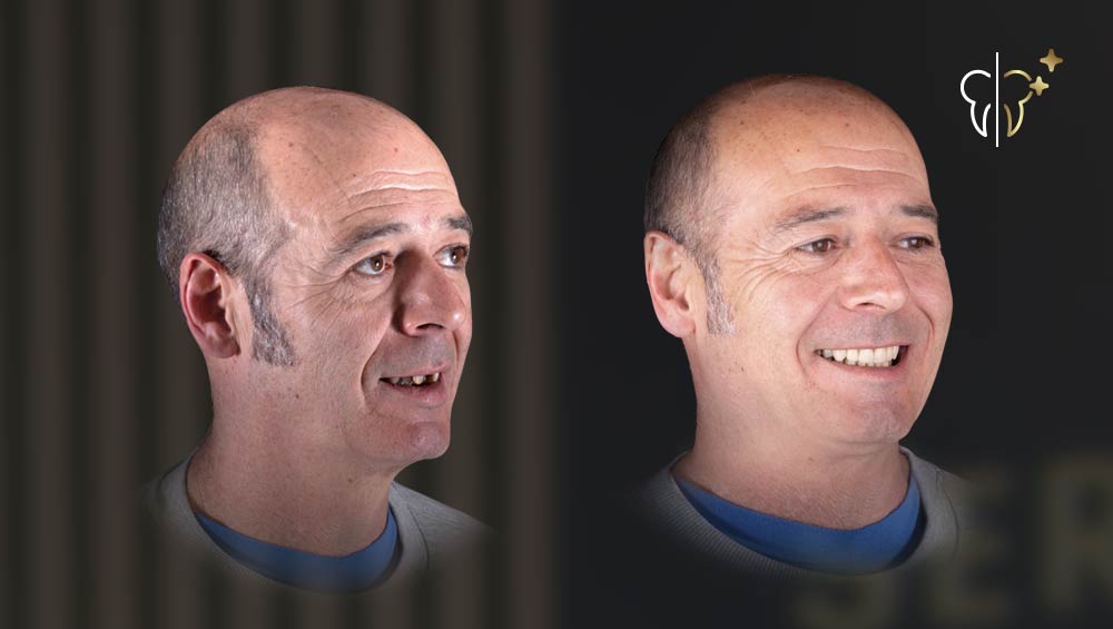 rehabilitación dental integral de lado